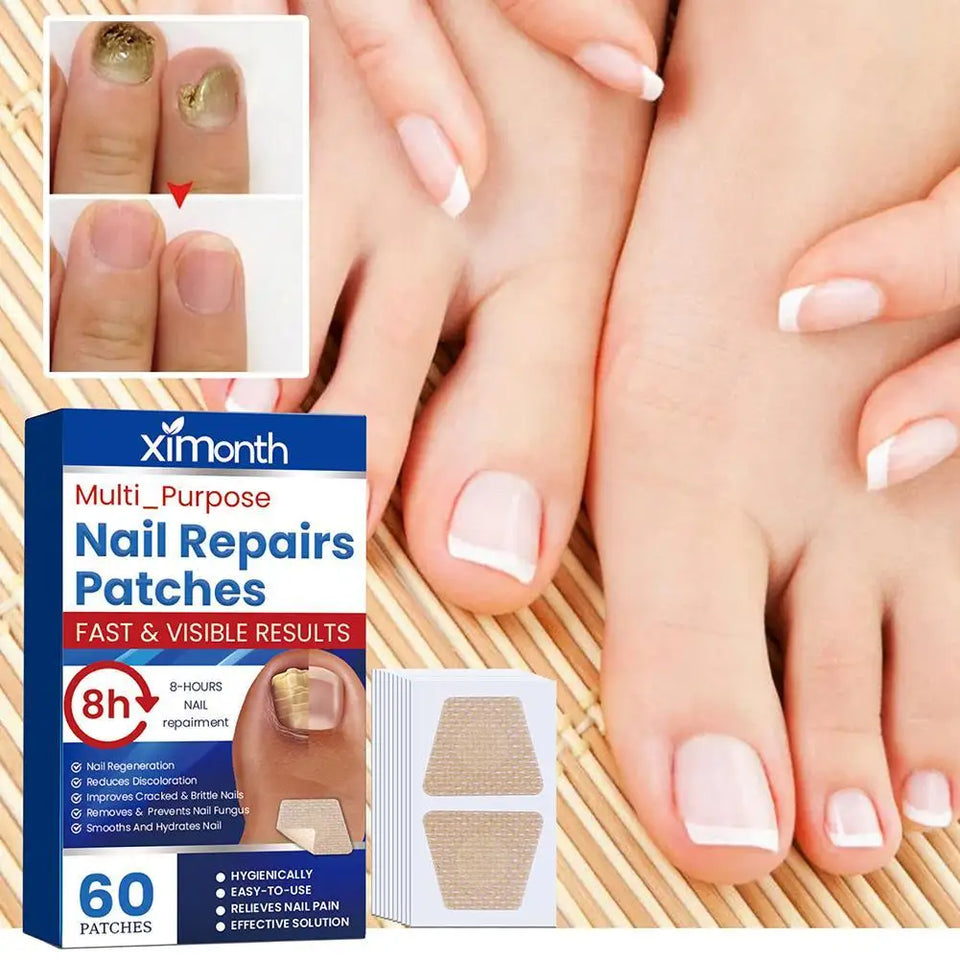 Afinmex™ Ingrown Toenail Corrector Patches