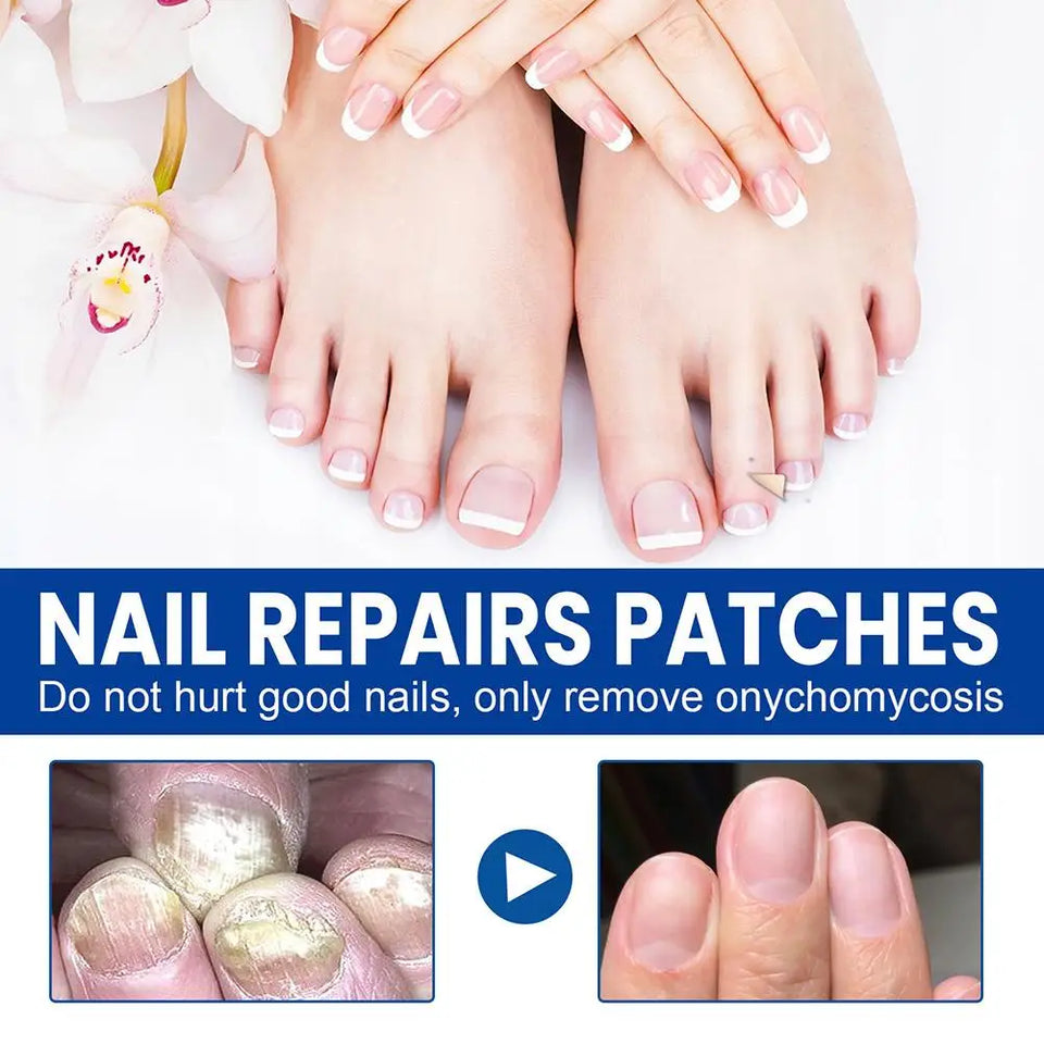 Afinmex™ Ingrown Toenail Corrector Patches