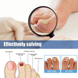 Afinmex™ Ingrown Toenail Corrector Patches